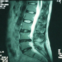 Herniated Lumbar Disc MRI